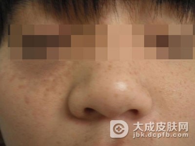 眼角出现雀斑的原因是什么