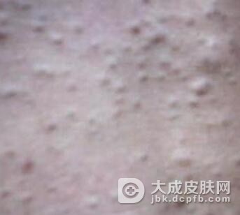 皮肤纤维瘤的注意事项是什么
