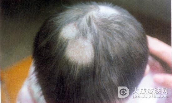 接触性及异位性皮炎的病理与预防