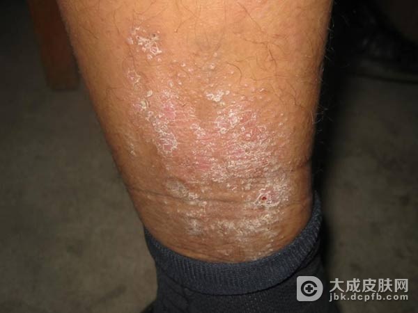 常见异位性皮炎如何预防