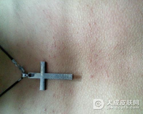 儿童异位性皮炎该怎么预防