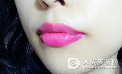 儿童口角唇炎的日常饮食以及治疗介绍