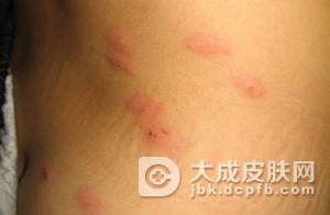 小儿性单纯痒疹由什么原因引起的