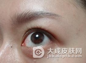 汗管瘤的治疗期要不要忌口