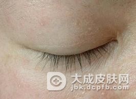汗管瘤在脱痂期后怎么护理