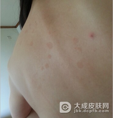 预防红斑狼疮有什么好的方法