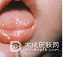 单纯型口腔粘膜白斑症状是什么