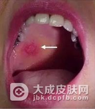 关于粘膜白斑的临床表现