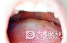 外阴粘膜白斑的白色病变
