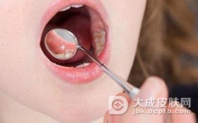 粘膜白斑应该的怎样治疗呢