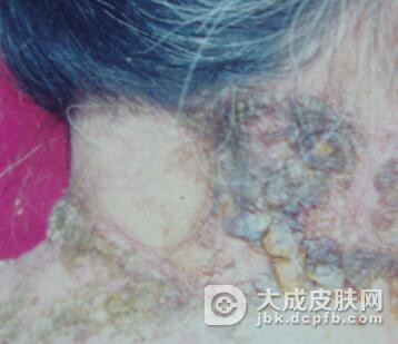 预防皮肤结核病的措施是什么呢