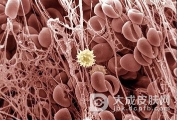 得了粘膜白斑如何的治疗
