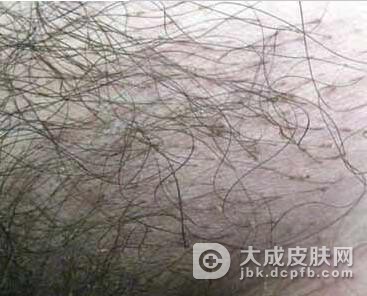 阴虱病的危害会有哪些