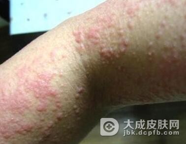 过敏性皮炎具体是怎么回事