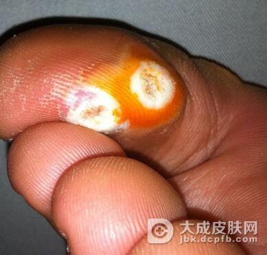 哪些方法可以有效的预防鸡眼的发生