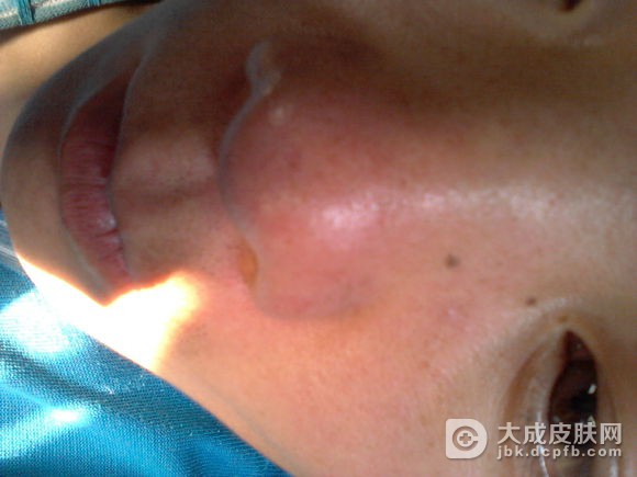 酒渣鼻有什么特点