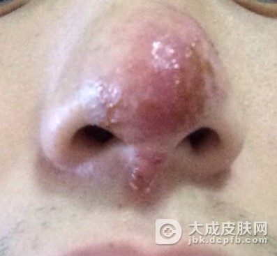 治疗酒渣鼻吃什么最好