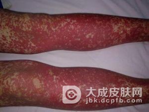 这个冬季远离过敏性紫癜