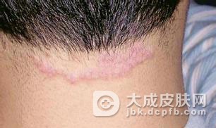 关节病型银屑病的发病原因