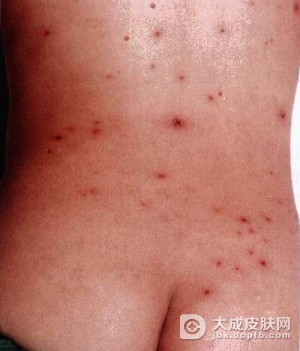 水痘的预防、护理