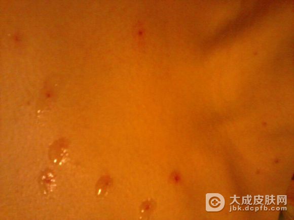 出现传染性软疣要怎么做呢