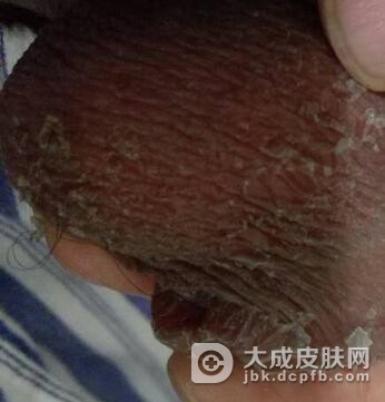 慢性阴囊湿疹有何特征