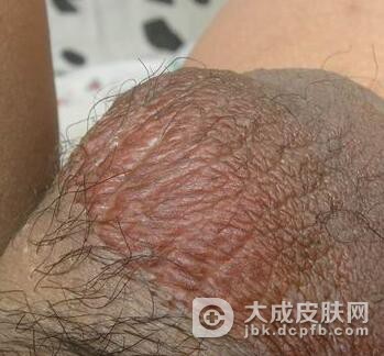 阴囊湿疹的治疗方法是有什么呢