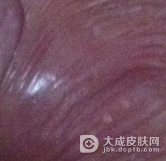 尖锐湿疣都有哪些传播途径