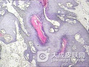 诱发口腔粘膜白斑的原因