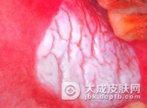 牙齿不齐造成粘膜白斑病