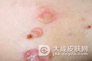 中医如何治疗化脓性汗腺炎