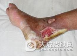 化脓性汗腺炎对人们健康的伤害