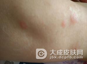 丘疹性荨麻疹患者需要跟哪些疾病相区别