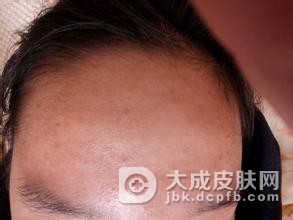 鼻头长粉刺的防治事项都有哪些
