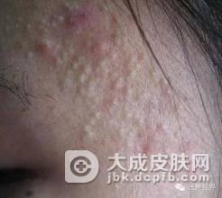 粉刺型痤疮的形成与什么有关