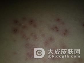 单纯疱疹病毒感染症常识概述
