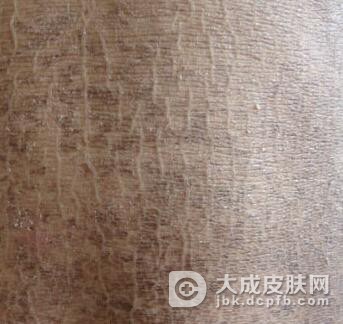 鱼鳞病患者的皮肤为什么会很干燥呢