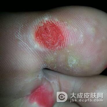 跖疣可以采取怎样的治疗方法
