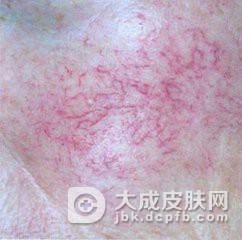 脸部有红血丝怎么的护理