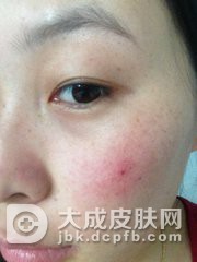 鼻头的红血丝如何护理