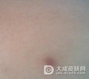 疤痕患者日常应注意哪些