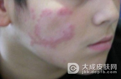 红斑狼疮患者的饮食注意事项