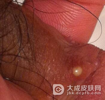 感染一期梅毒为何及早治疗