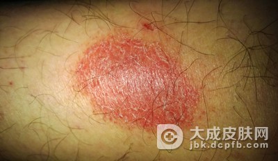 生殖器疱疹对胎儿的危害