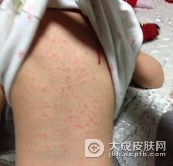 潜伏期一期梅毒有好的治疗方法吗