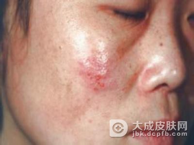 治疗生殖器疱疹有了四大突破