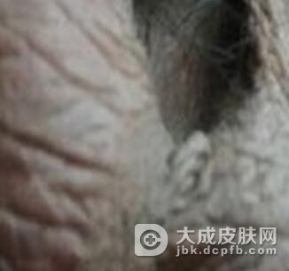 阴囊湿疹要注意什么事情呢