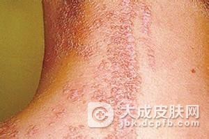 放射性皮炎主要的病发原因是哪些