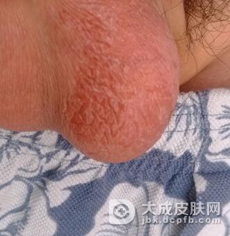 阴囊湿疹有什么特征表现