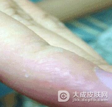 汗疱疹相鉴别的疾病